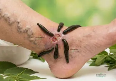 Leech Therapy for Chronic Varicose Ulcers